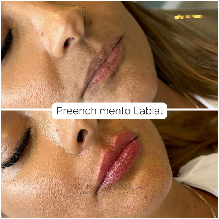 Preenchimento Labial