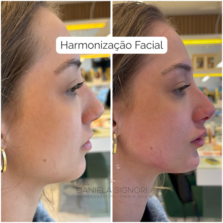 Harmonização Facial