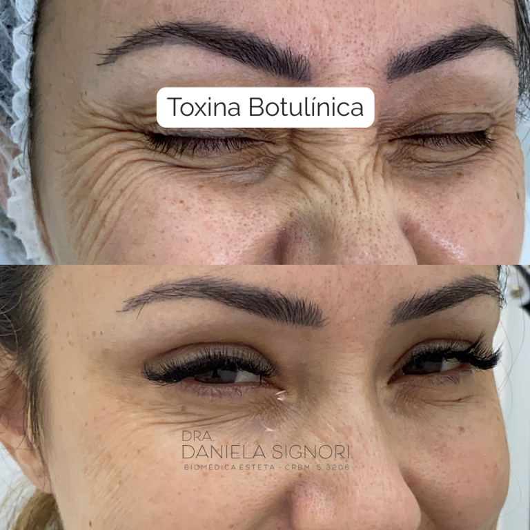 Toxina Botulinica