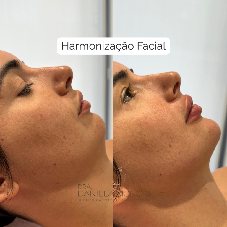 Harmonização Facial