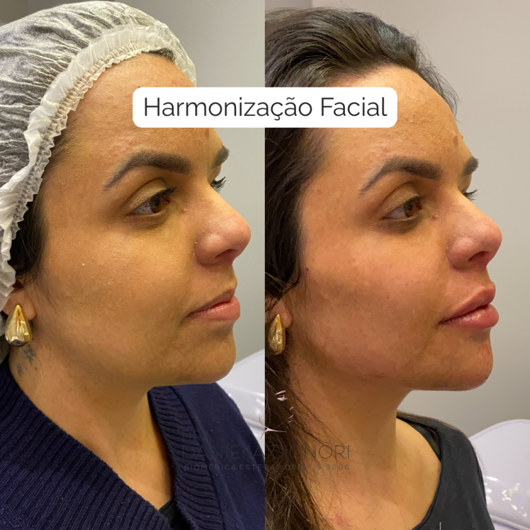 Harmonização Facial