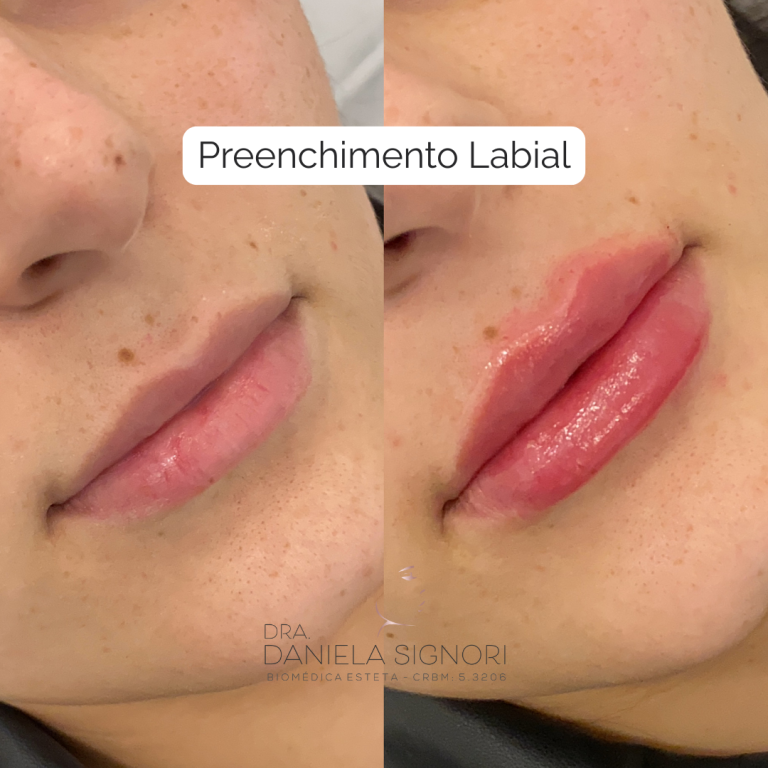 Rinomodelação com Ácido Hialurônico (4)