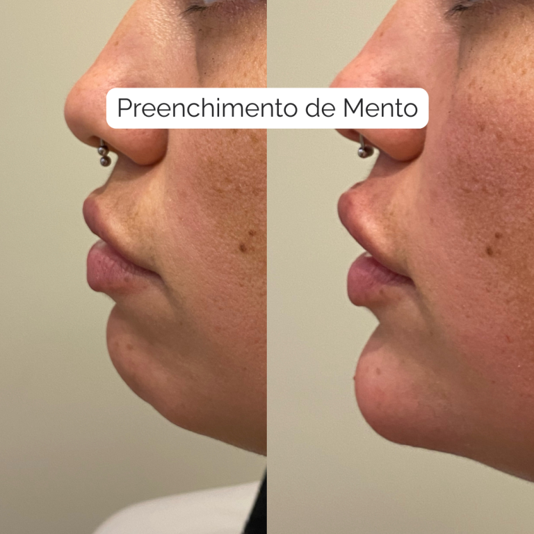 Preenchimento de mento