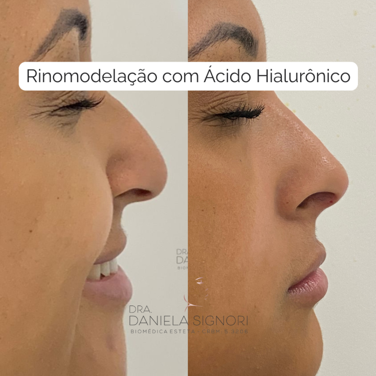 Rinomodelação com Ácido Hialurônico (6)