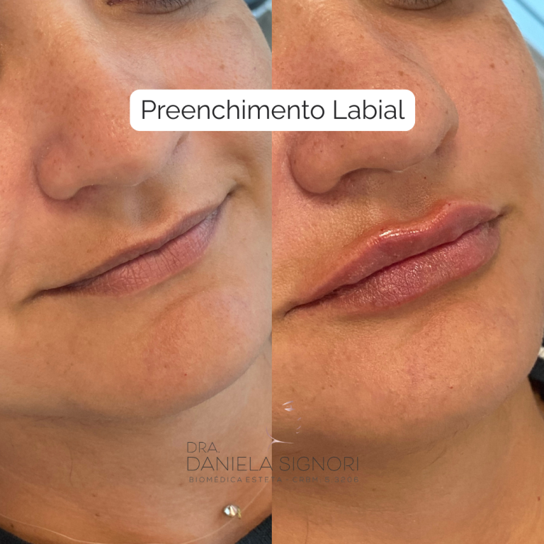 Preenchimento Labial