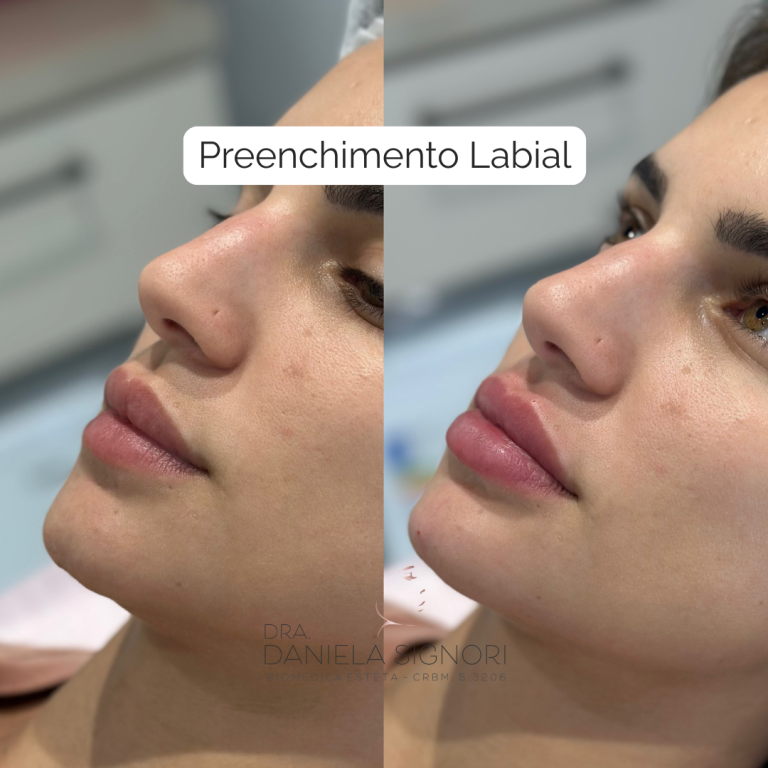 Preenchimento Labial