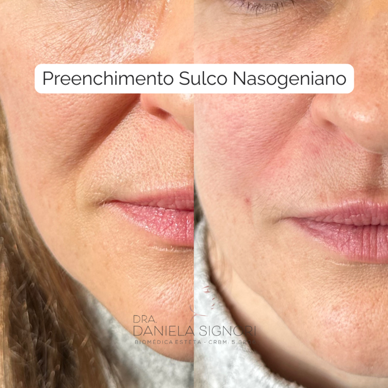 Rinomodelação com Ácido Hialurônico (9)