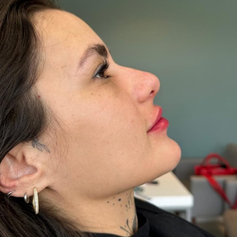 Perfiloplastia não cirúrgica