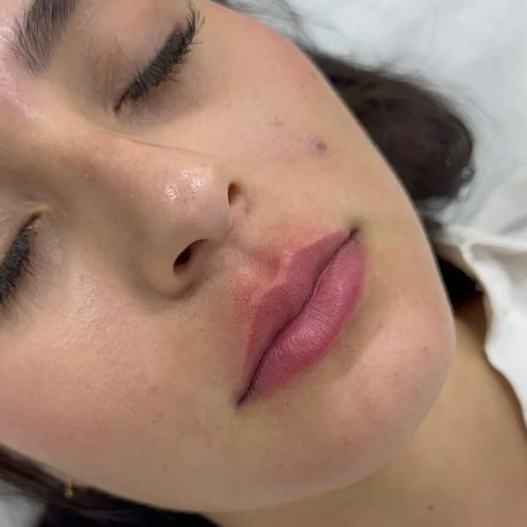 Preenchimento Labial​